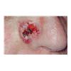 Carcinoma Basocelular | Patologias Dermatologicas